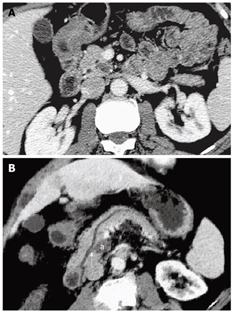 Imaging Features Of Intraductal Papillary Mucinous Neoplasms Of The