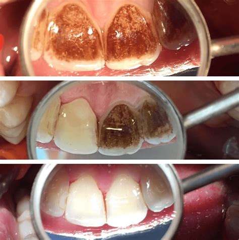 Before And After Dental Scale And Polish Procedure
