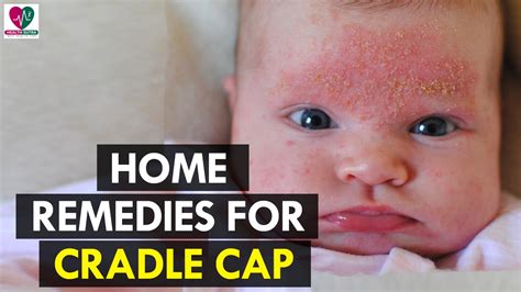 Home Remedies For Cradle Cap Health Sutra Youtube