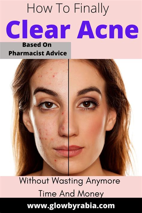 Skin Care Acne Acne Prone Skin Clear Acne Fast Diy Acne Mask Face