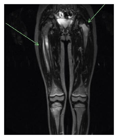 Mri Lower Extremities Showed Multifocal Abnormal Bone Marrow Signal In