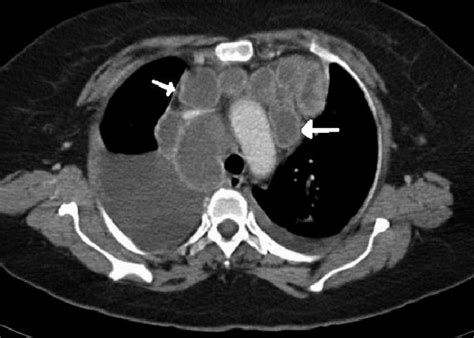 Ct Scan Picture Showing Massive Mediastinal Lymphadenopathy With