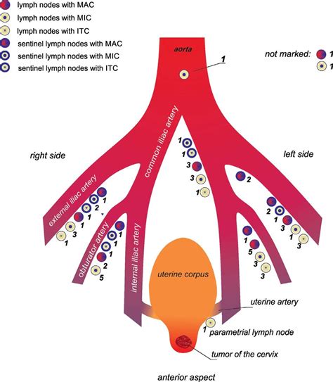 Distribution Of Lymph Nodes Events In 27 Patients With Ultrastaging