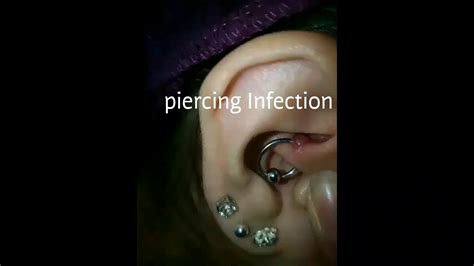 Get Rid Of Piercing Infections Fast Youtube