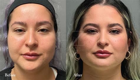 Buccal Fat Removal Before After HZ Plastic Surgery