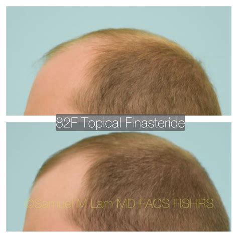 This 27 Year Old Gentleman Is Shown Before And Five Months After Starting Topical Finasteride