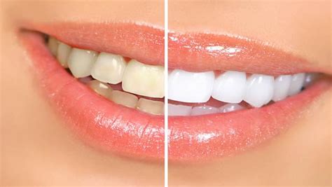 Sonicare toothbrush (most effective with my kids, recommended by the pediatric dentist, something about the vibration of the toothbrush). How to remove teeth stains naturally at home - 9 tips