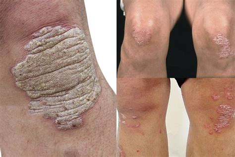 Psoriasis On Knees Causes Symptoms And Treatment Psoriasis Expert