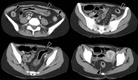 Figure1 Contrast Enhanced Abdominal CT Images At Admission The Images