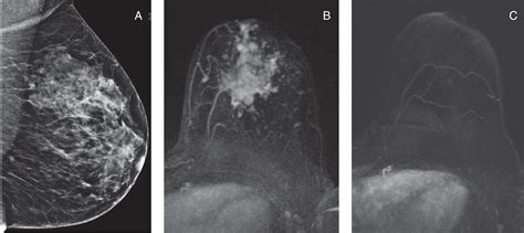 Conventional Breast Imaging Radiology Key