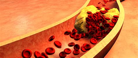 Veins carry blood from the body back into the heart. Ratgeber Thrombose: So erkennen Sie einen Gefäßverschluss