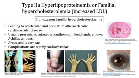 Hyperlipidemia Etiology Epidemiology Clinical Features