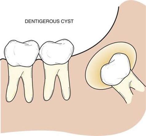 Dentigerous Cyst Focus Dentistry