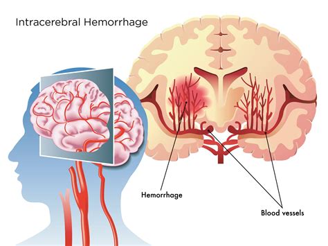Tipos De Hemorragia Cerebral Sexiz Pix