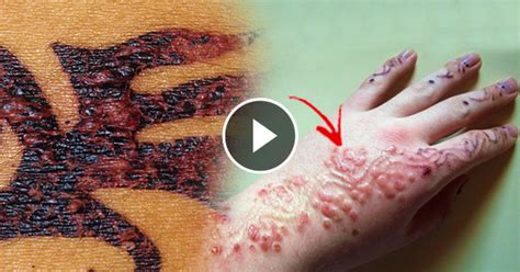 Temporary black henna tattoo design henna tattoo design forearm arm. 'Black Henna' Tattoo Causes Allergic Reaction to Skin That ...