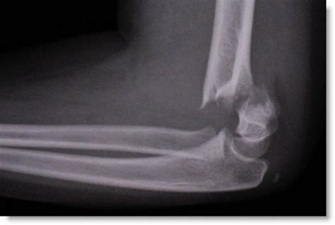 Briefs: What a nerve (injury in elbow fractures) - PEMBlog