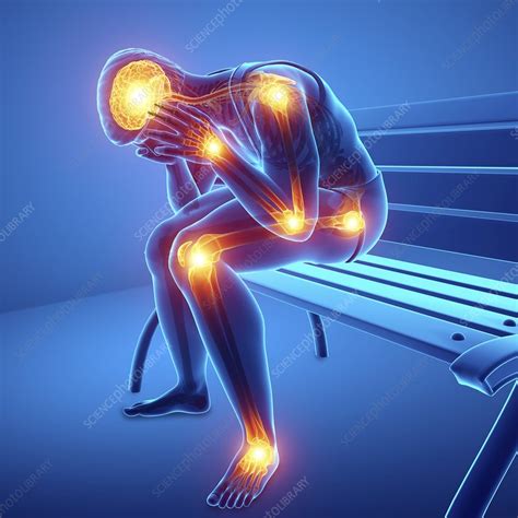 Man With Joint Pain Illustration Stock Image F0226287 Science