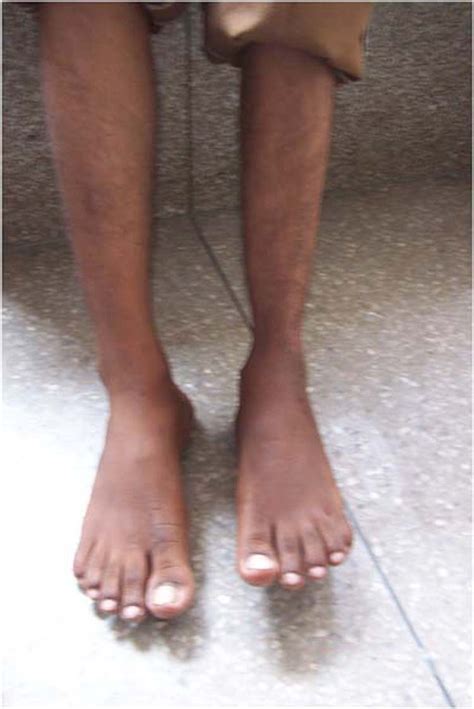 Chondroblastic Osteosarcoma Of The Lower Tibia A Case Report The