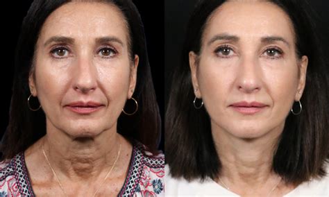 Beautiful Natural Facelift Results In San Diego By Expert Plastic Surgeon Dr Hilinski