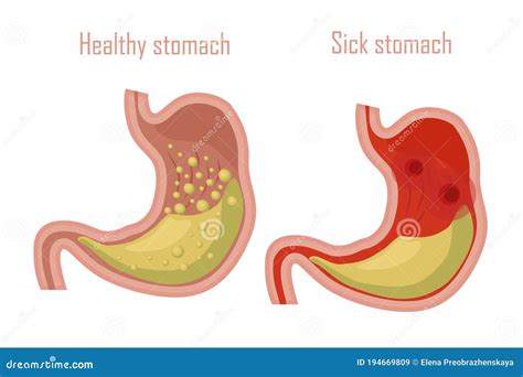 Human Stomach Digestive System A Healthy And Sick Stomach Vector