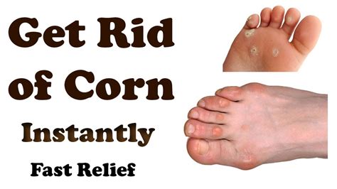 Corn Removal Home Remedies For Corns On Toes How To Get Rid Of Corn Youtube