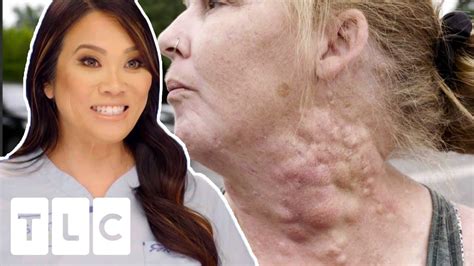 Woman’s Medication Makes Bumps Grow All Over Her Neck Dr Pimple Popper Pimple Popping Videos