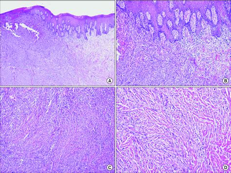 Histopathologic Appearance Of Desmoplastic Melanoma A Spindle Shaped