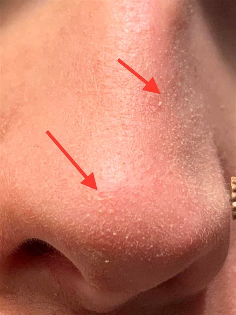 How Can I Get Rid Of Dry Flaky Skin On My Face Do I Need A Better Way