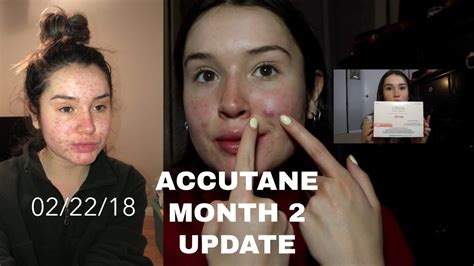 My Accutane Journey Month Update Youtube