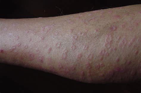Dermatitis On Leg Pictures Photos