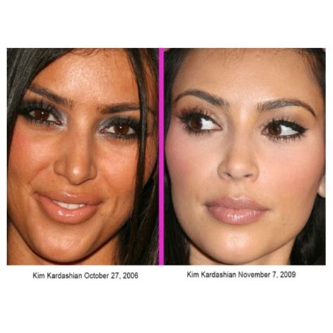 Yikes Notice A Difference Kardashian Plastic Surgery