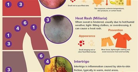 Medical And Health Science Common Rashes
