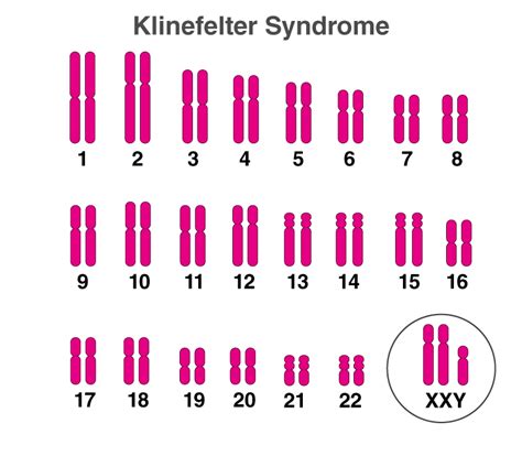 Genetic Causes Of Klinefelter Syndrome Free Nude Porn Photos Sexiz Pix