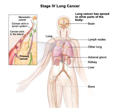 Lymph node involvement at the time of breast cancer diagnosis or surgery is the single most important anatomic predictor of risk of spread (metastasis) to other areas of the body. Metastatic Lung Cancer: Symptom, Diagnosis and Treatment ...