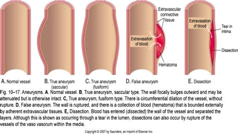 A ruptured aneurysm is a medical emergency. Vessel Diseases - StudyBlue