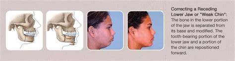Corrective Jaw Surgery Orthognathic Surgery Jaw Misalignment Aaoms