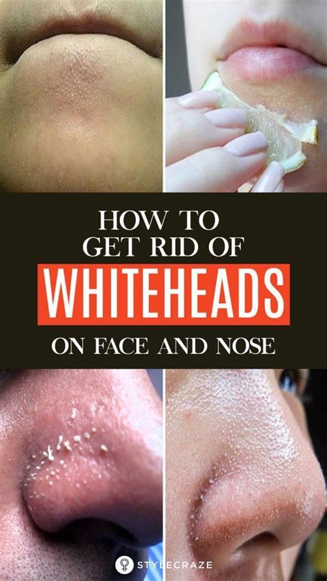 25 Best Remedies To Get Rid Of Whiteheads On Face And Nose In 2020
