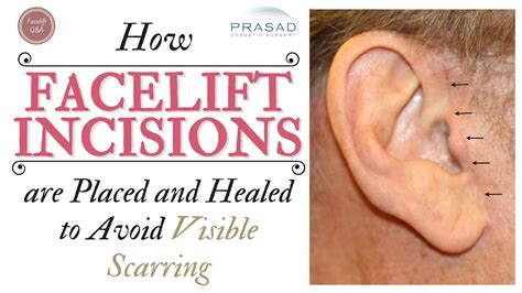 How Visible Facelift Incision Scars Are Avoided Treated And Healed