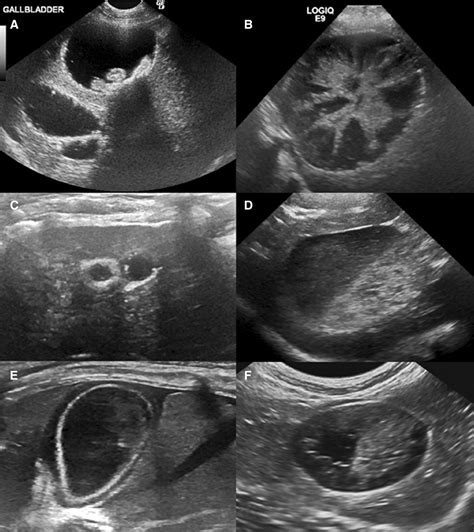 Diseased Gallbladder Ultrasound