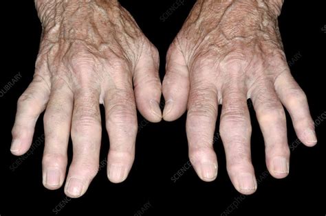 Hands In Erosive Osteoarthritis Stock Image C0478457 Science