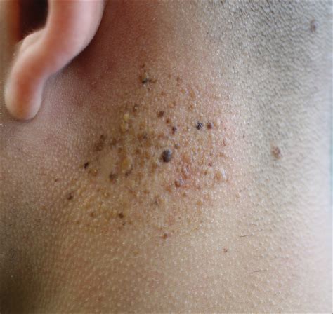 Agminated Heterogeneous Papules On The Neck Mdedge Dermatology
