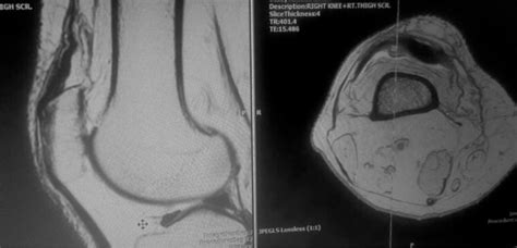 Quadriceps Tendon Tear Mri Sumers Radiology Blog