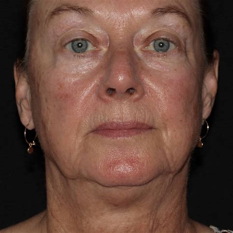 rosacea redness birth marks port wine stains dermatology of the rockies