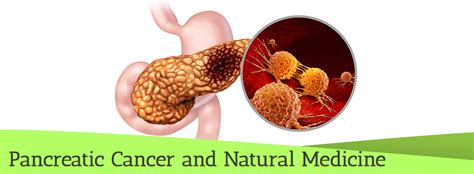 Pancreatic Cancer Natural Treatments Herbs