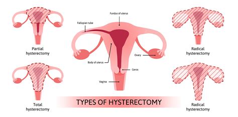 Vnotes The Newest Non Invasive Hysterectomy Procedure Azgyn