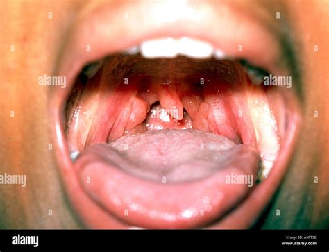 Swollen Tonsils Hi Res Stock Photography And Images Alamy