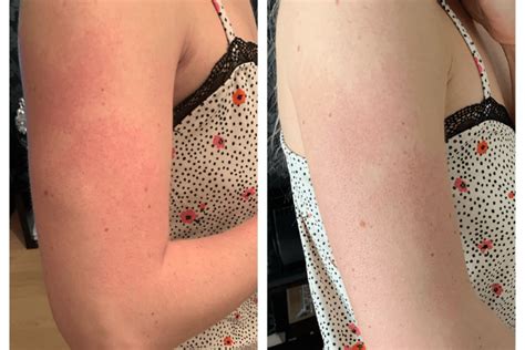 Treating The Red Bumps On My Upper Arms Testimonial Ameliorate