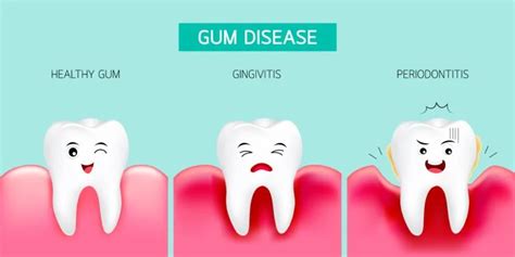 Plaque And Gum Disease • Synergy Dental Clinic