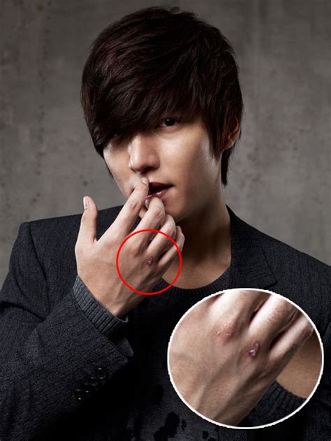 K Popk Drama Lee Min Ho Gets Scar From Filming “city Hunter