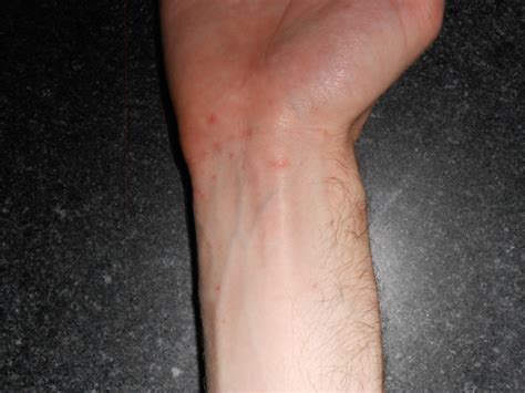 Scabies Worse After Treatment